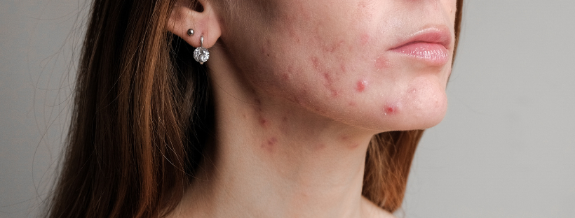 Inflamm-Aging & Acne: What Every Skin Professional Should Know