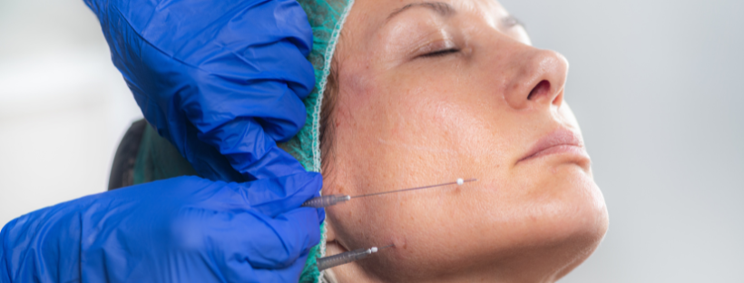 Face Value – Thread Lifts: Lifting the Myths